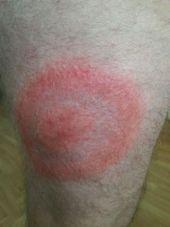 Erythema migrans