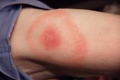 Erythema migrans